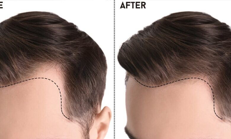 Best Hair Transplant in Pakistan